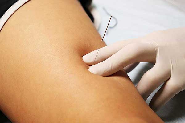 Dry Needling